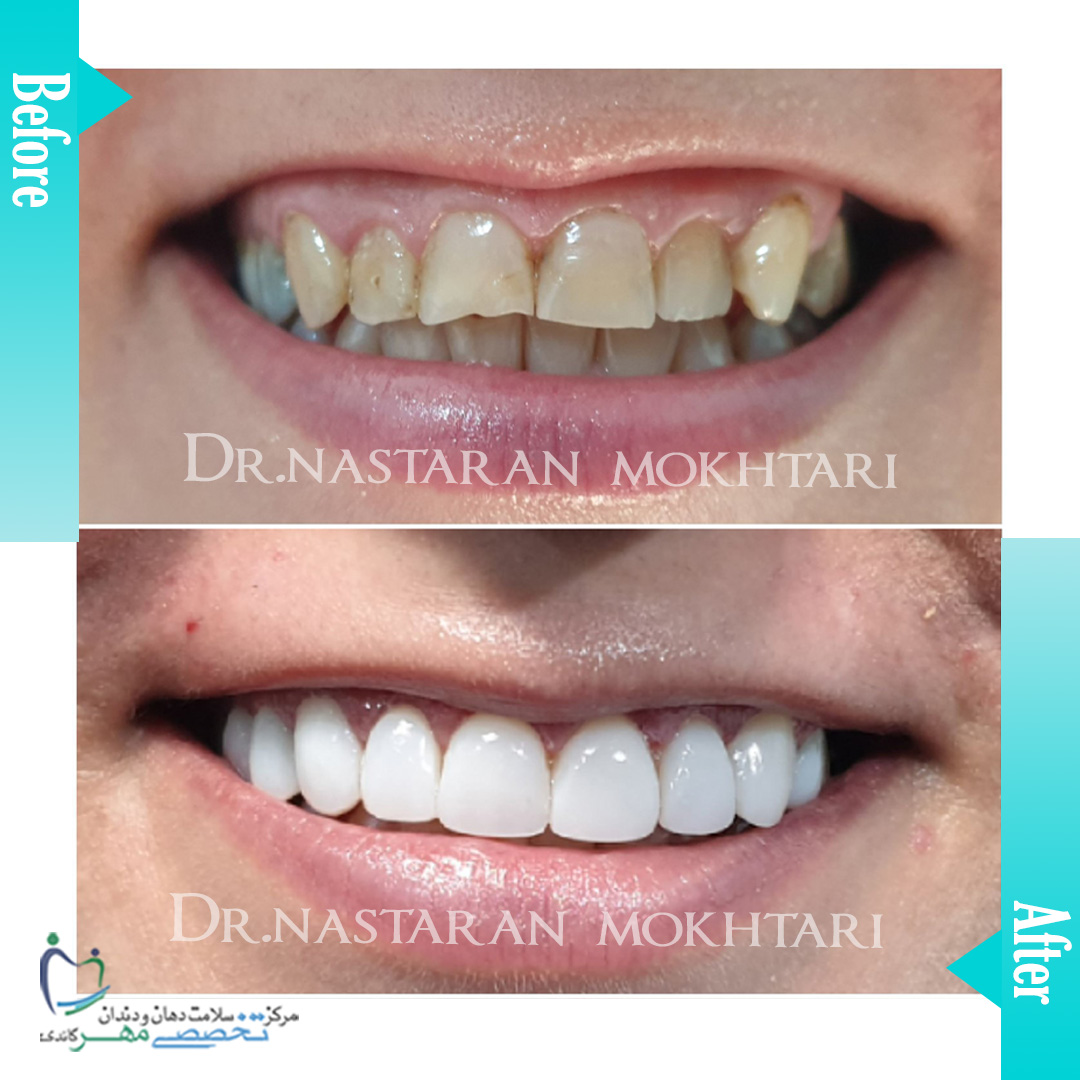 دکتر نسترن مختاری - متخصص ترميمی و زیبایی (کامپوزیت ونیر / لمینیت کامپوزیتی)